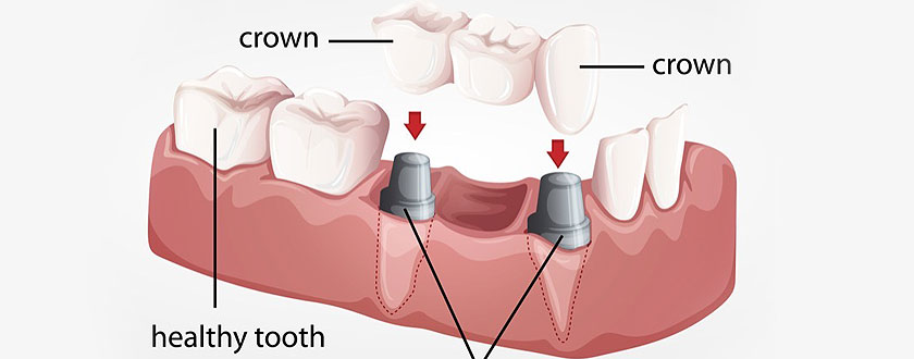 Dental Bridge & Crown