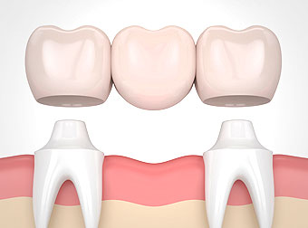 Dental Bridge & Crown Close-up