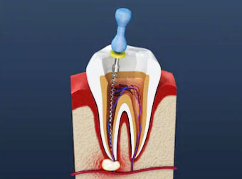 Root Canal Procedure