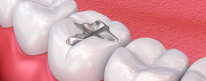Dental Filling Image