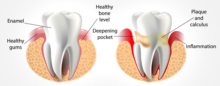 Gum Treatment