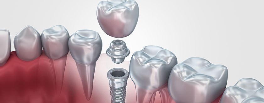 Dental Implant Procedure